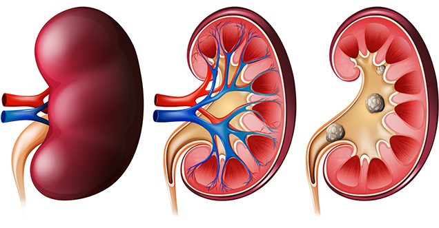 Kidney Transplant