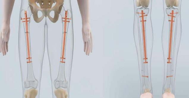 Lengthening Surgery